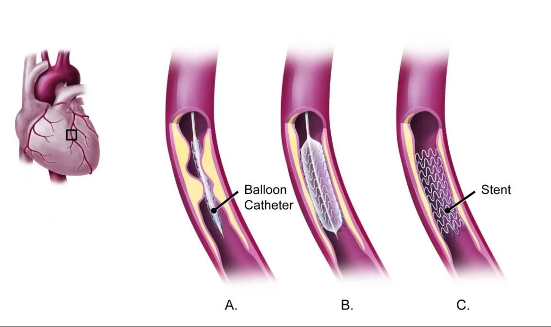 advanced heart care services, including angiography and angioplasty,