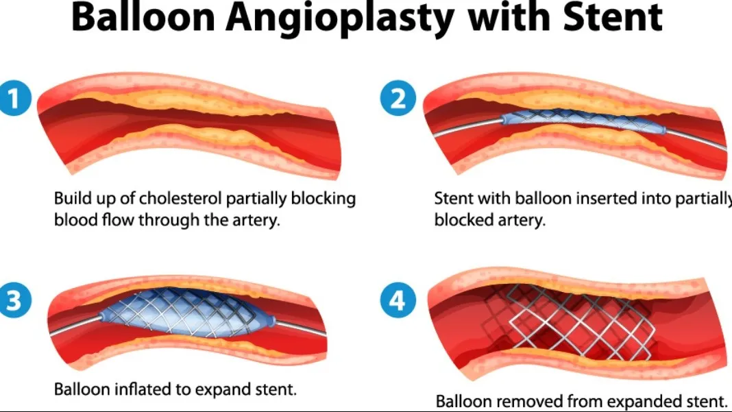 heart treatments and angioplasty, through the PMJAY and MJPJAY schemes. hospital has a modern cathla