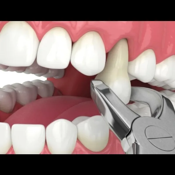 Extraction Treatment In Vashi