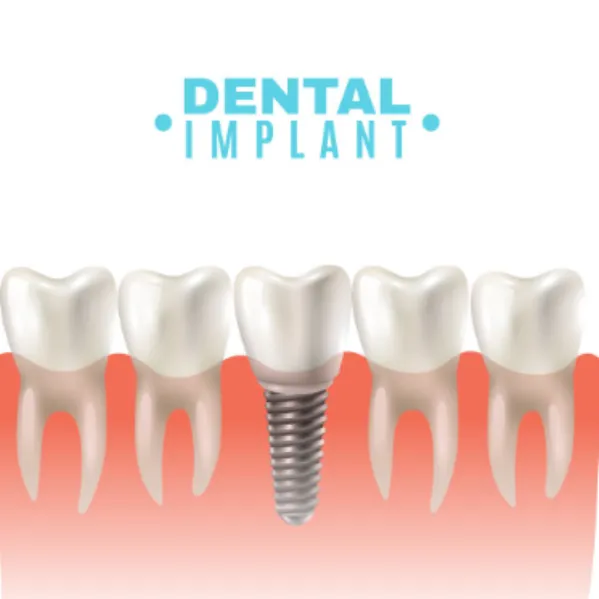 Experienced Dental Implant Doctor in Dwarka Why Expertise Matters in Long-Term Results