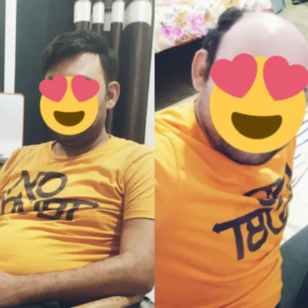 Q6 Hair Patch in Nagpur – Latest Update on High-Definition Scalp Finish