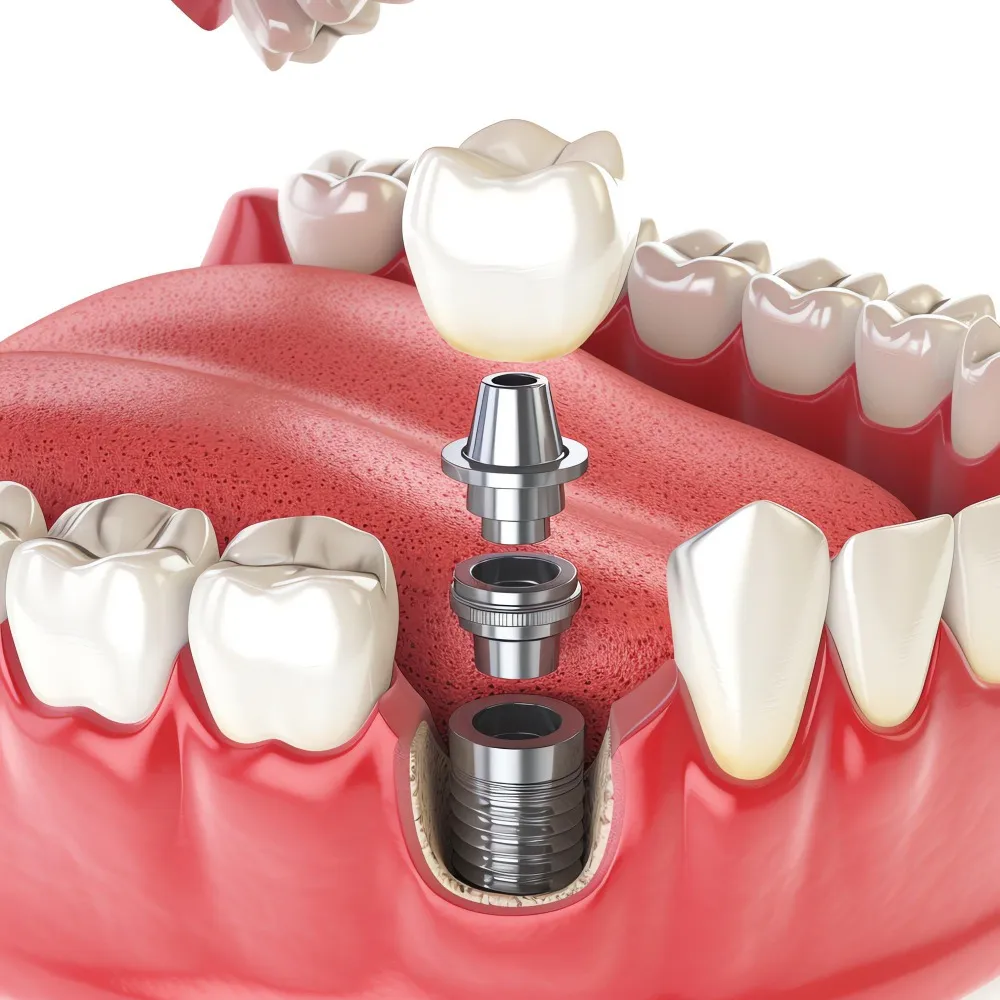 Best Affordable Dental Implants in Dwarka for Long-Lasting Tooth Replacement