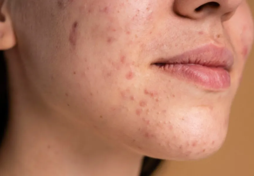 Acne Treatment in Mumbai - Effective Dermatology Care for Clearer Skin