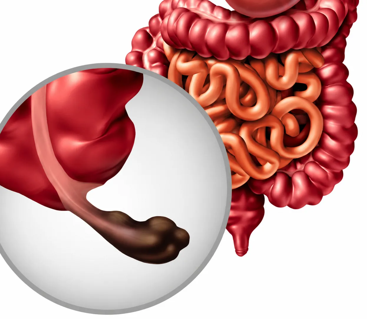 Appendix Surgery Specialist in Pune Surgical Care with Timely Intervention