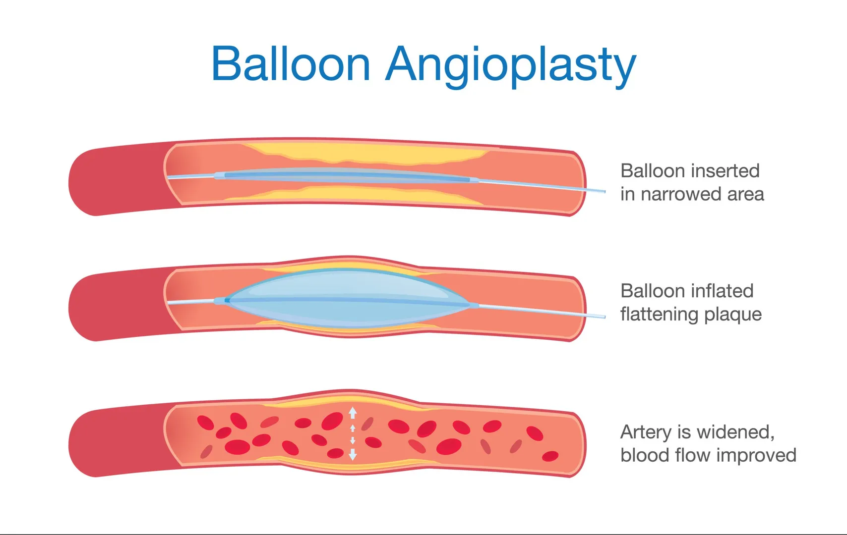 Looking for free angioplasty treatment near Karvenagar, Pune? Platinum Hospital is a trusted multisp...