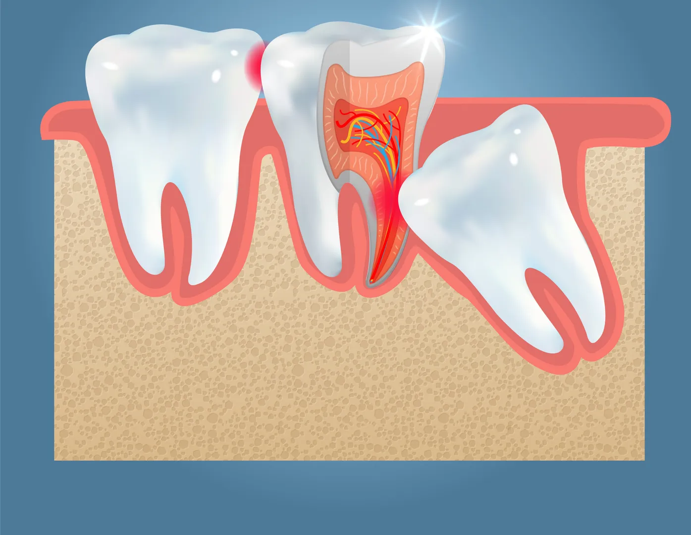 Wisdom Tooth Removal Treatment in Hebbal