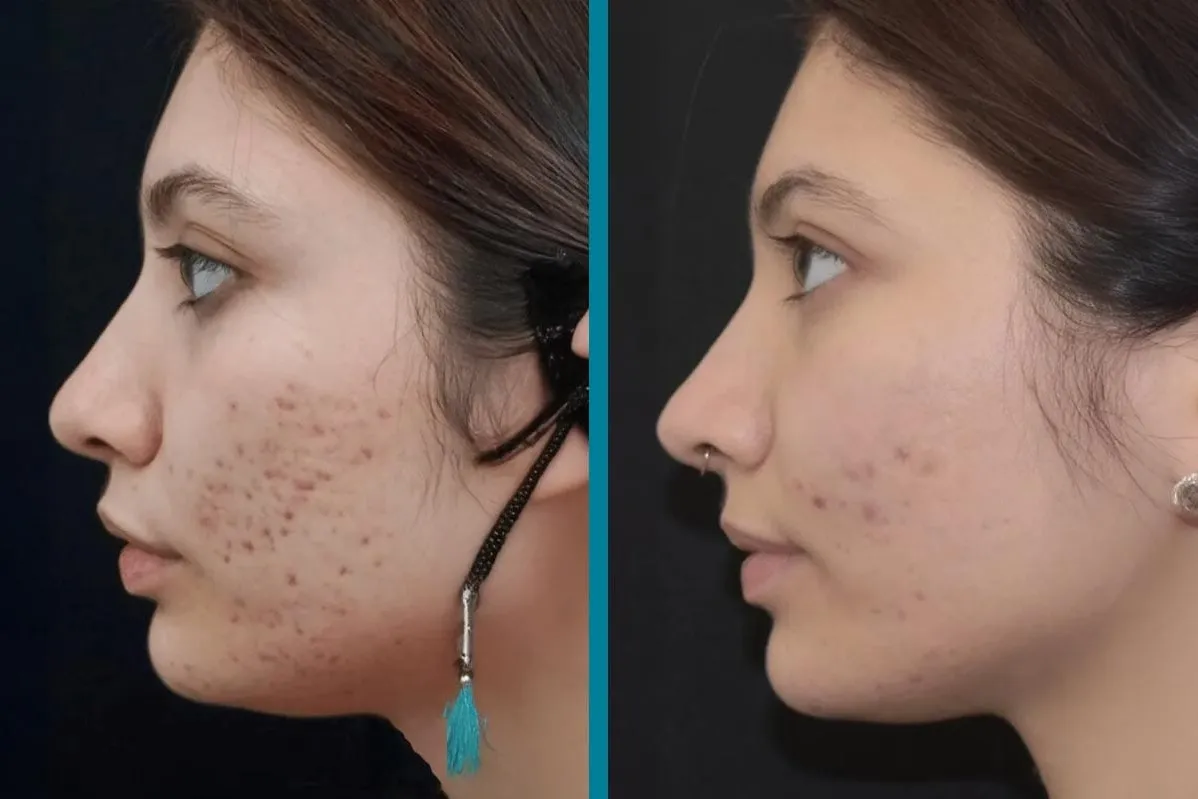 Acne & Acne scar Treatment In Vashi