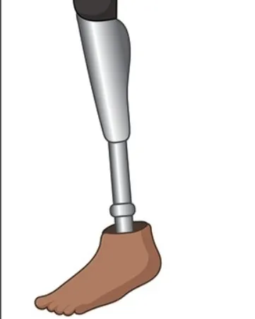 Above Knee Prosthesis Customize By order IN KALWA