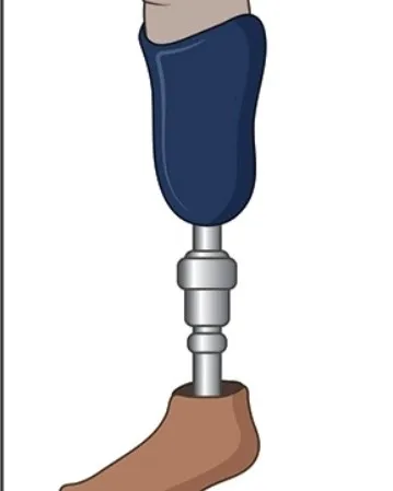 Below Knee Prosthesis Customize By order Available Near Chatrapati Shivaji Maharaj Hospital kalwa