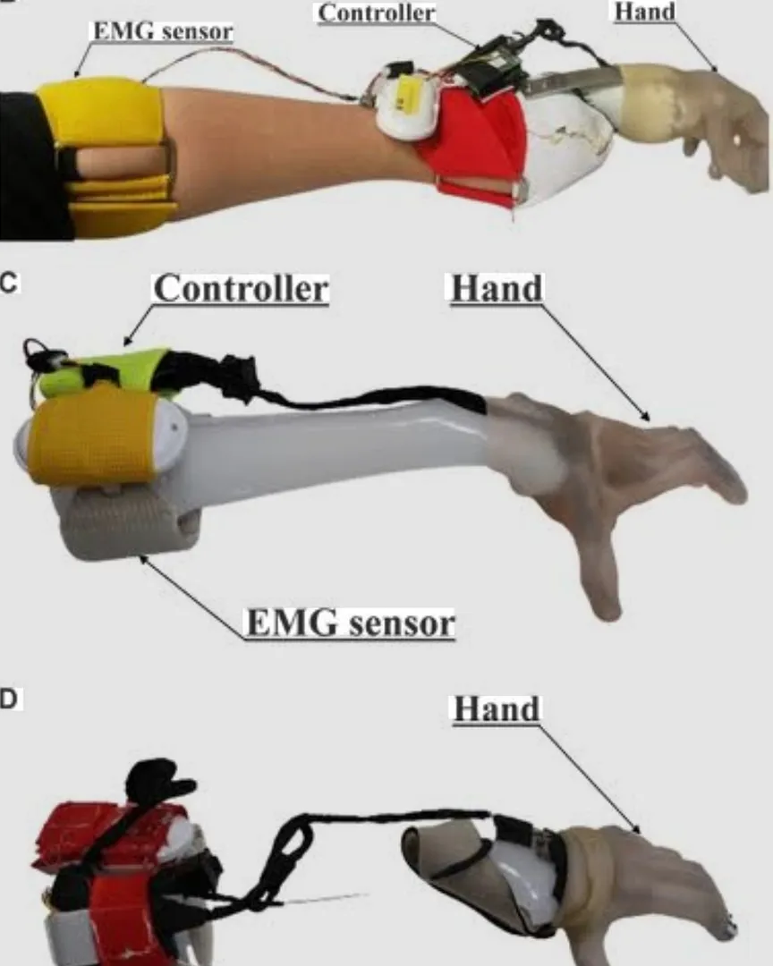Myoelectric Prosthesis Customize Ortho Product Available in Kalwa