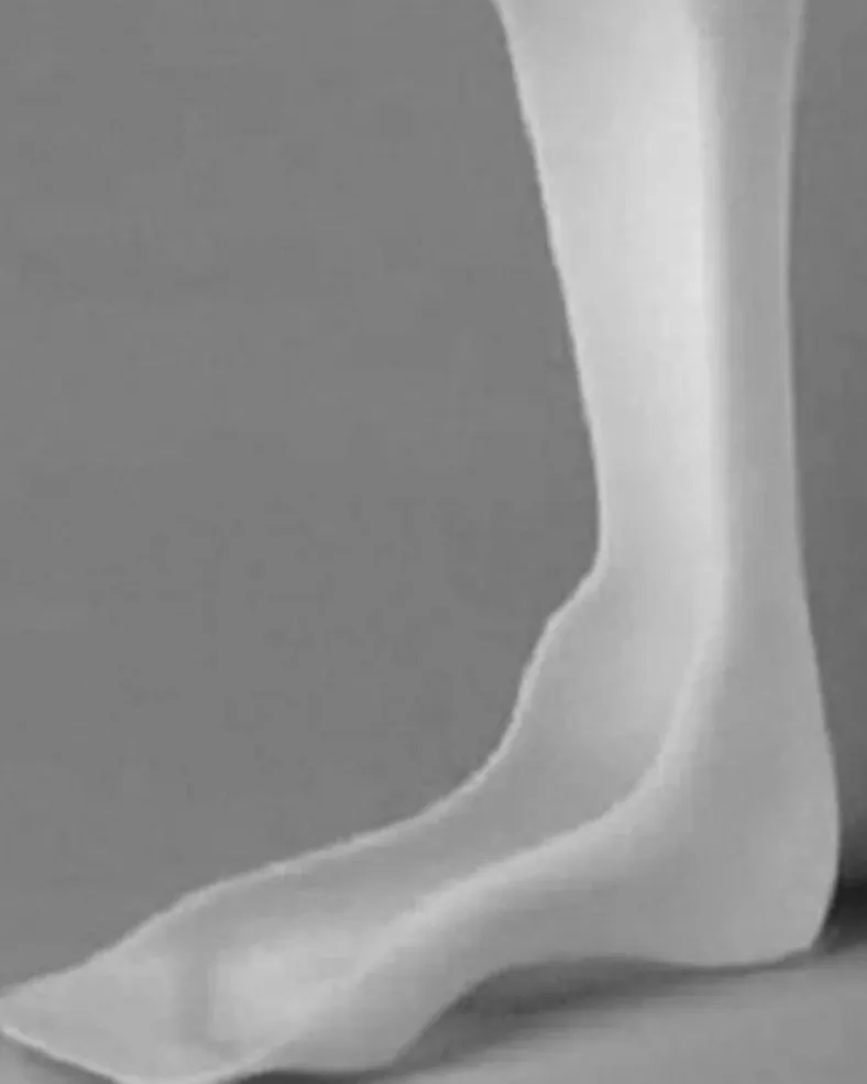 Dynamic AFO (Ankle Foot Orthosis) Available in Thane