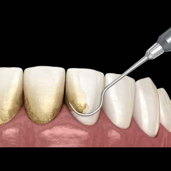 Scaling/cleaning of teeth treatment In vashi