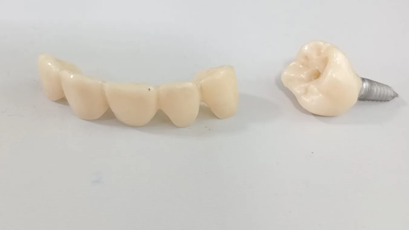 Dental Implant vs Bridge: Which Option Is Better for Missing Teeth in Thane?