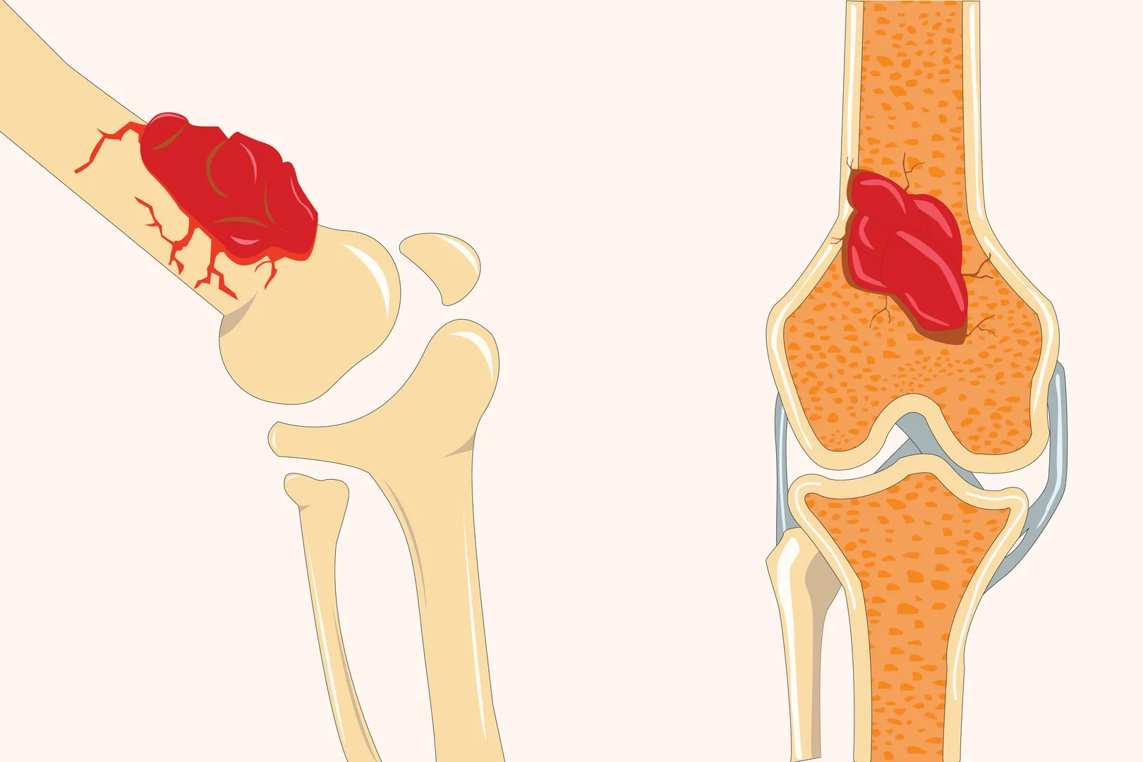 Soft Tissue Sarcoma in Mumbai – Recognising Unusual Swelling Before It Grows Further