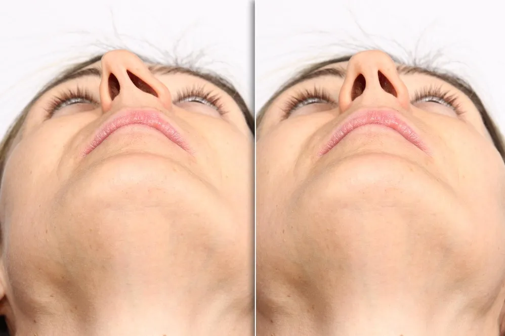 Nose Job Specialist in Pune for Natural-Looking Nasal Enhancement