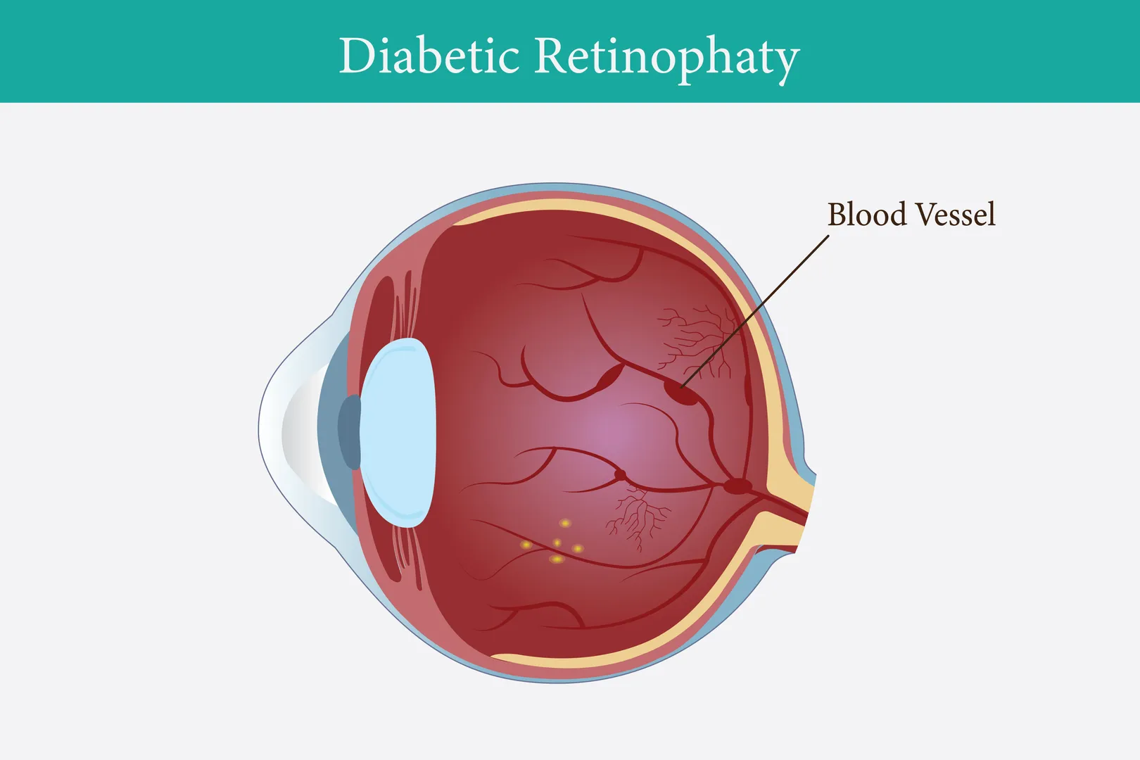 Diabetic Retinopathy Treatment in Panchkula