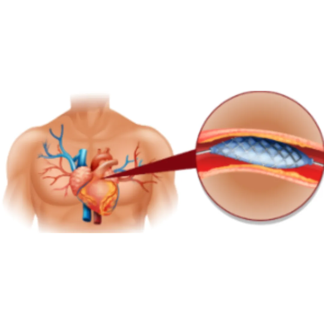 Completion Angiography in Nagpur for Accurate Cardiac Surgery Assessment