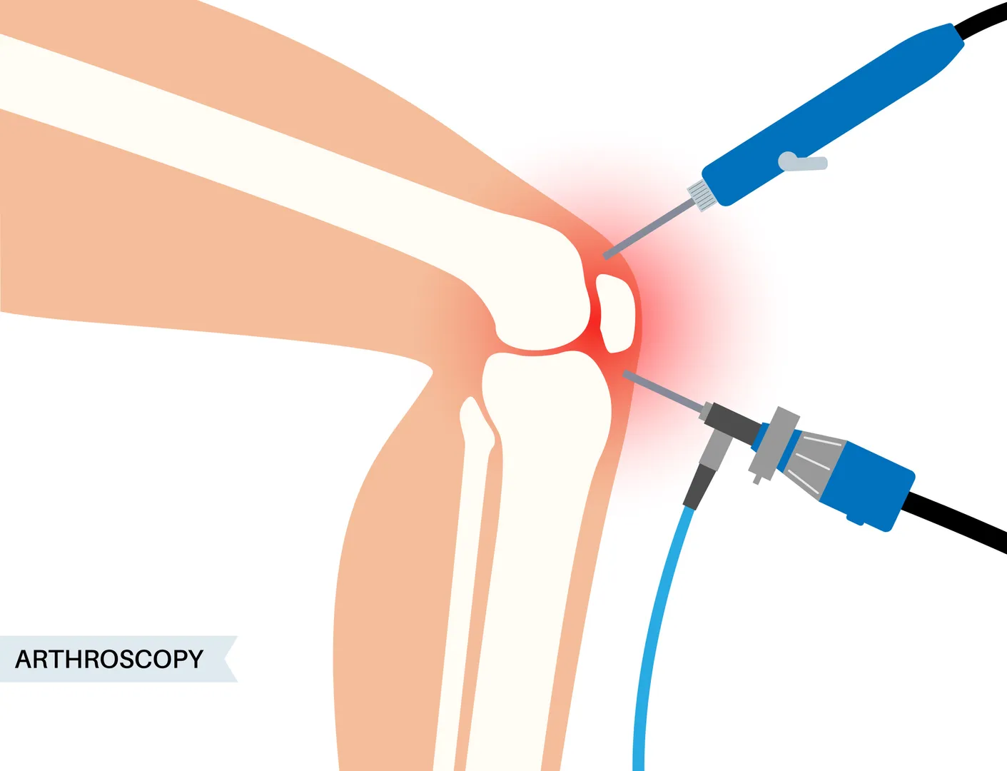 Knee Arthroscopy Treatment in Mumbai – A Modern Approach for Active Knees