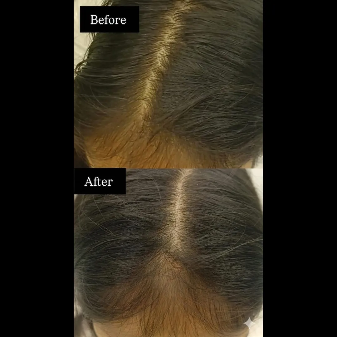 Scalp Peel Treatment In Vashi