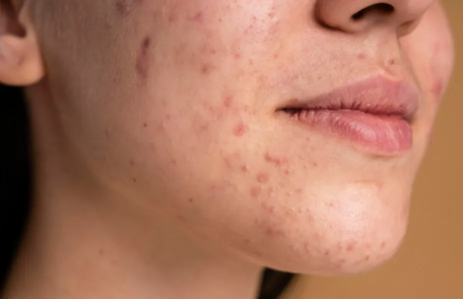 Acne Scar Removal Treatment in Besant Nagar | Smoother Skin with Professional Care