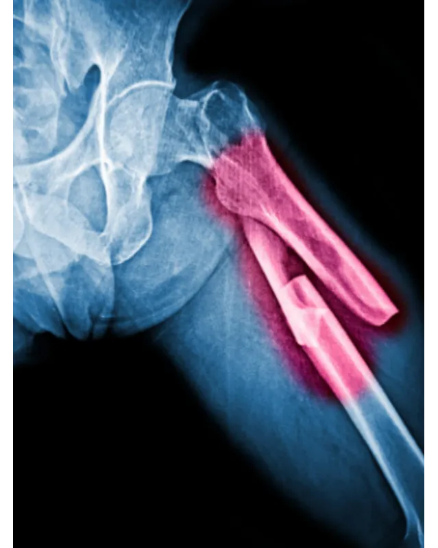 Pathological Fractures in Mumbai – When a Minor Fall Leads to a Serious Bone Concern