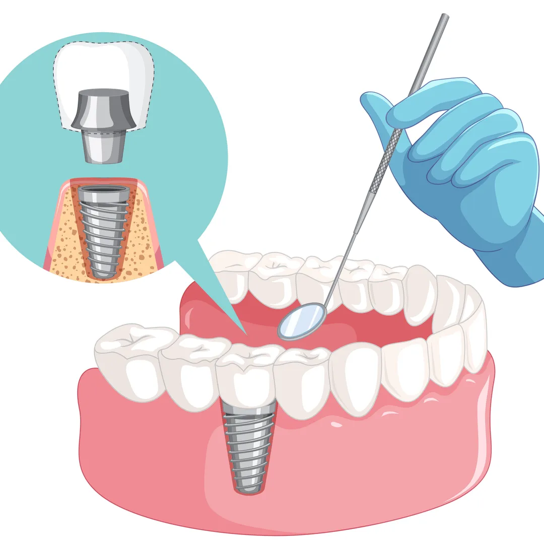 Best Dental Implant Specialist in Jaipur – Dr. Nidhi Goyal