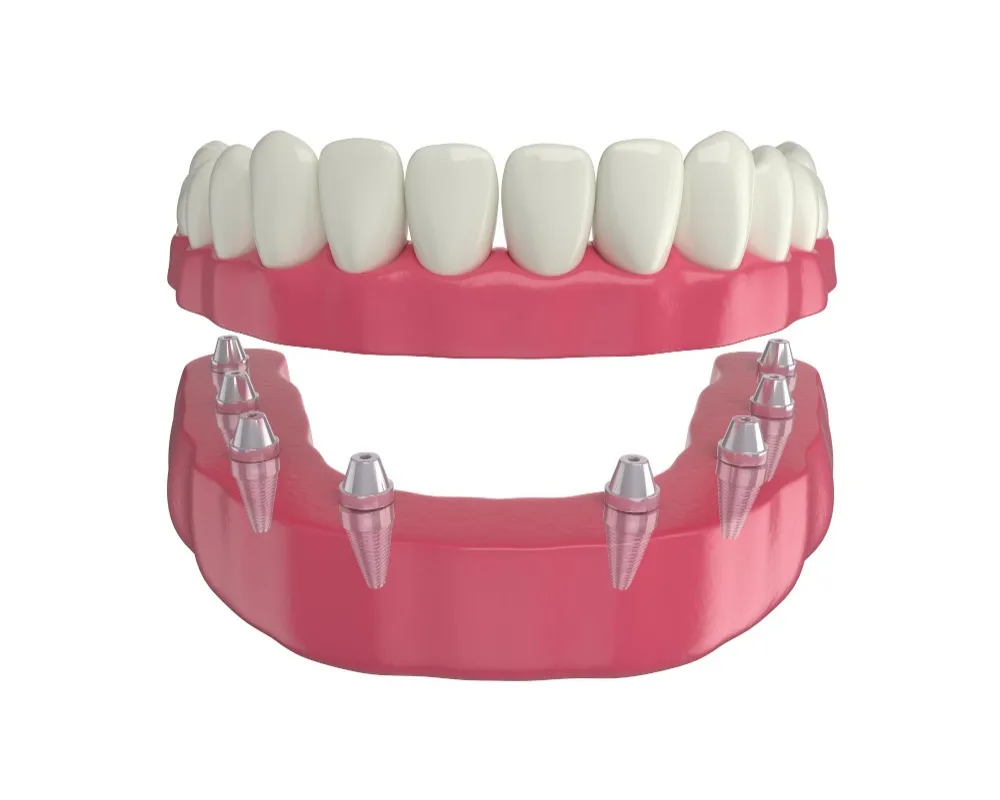 Fixed Dentures Clinic in Dwarka for a Secure and Natural Teeth Replacement Option