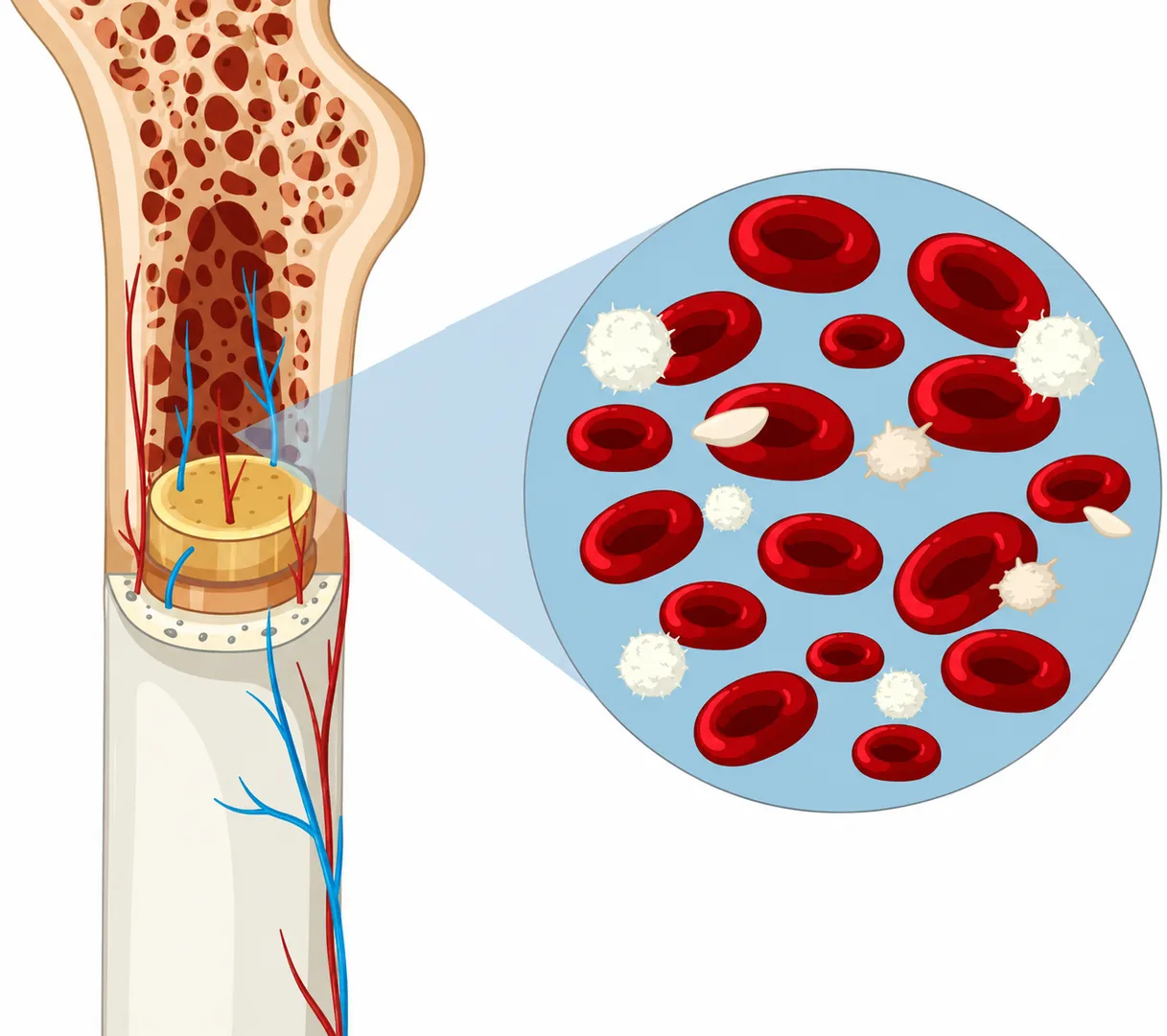 Ewings Sarcoma in Mumbai – Understanding Rare Bone Tumors in Younger Patients