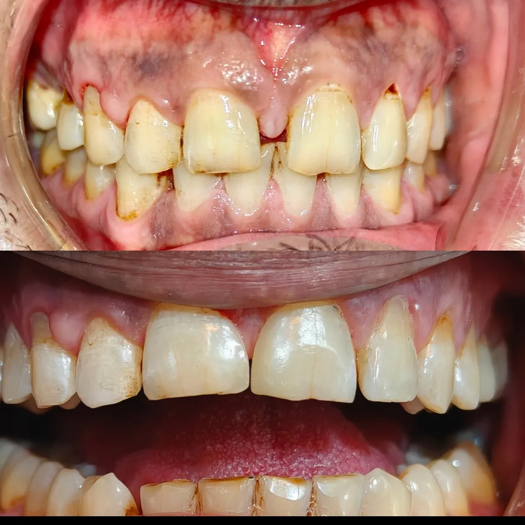 Aesthetic composite build up