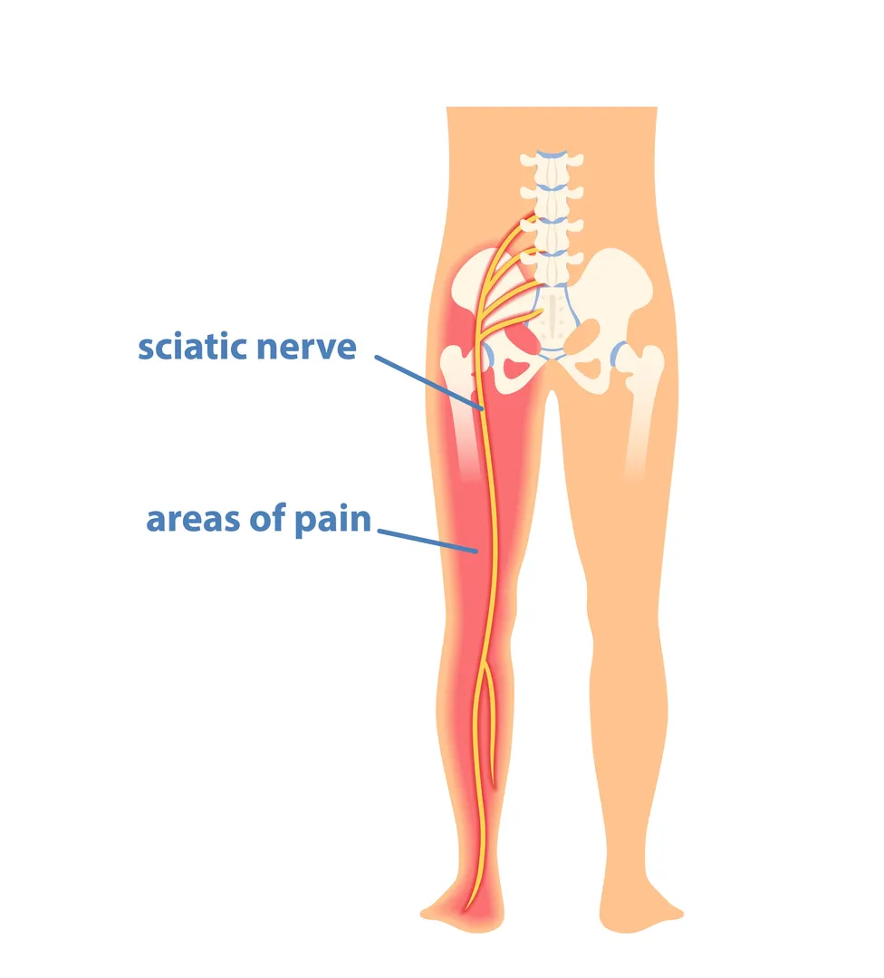 Sciatica Pain Relief Centres in Nagarbhavi for Nerve Pain That Travels Beyond the Back