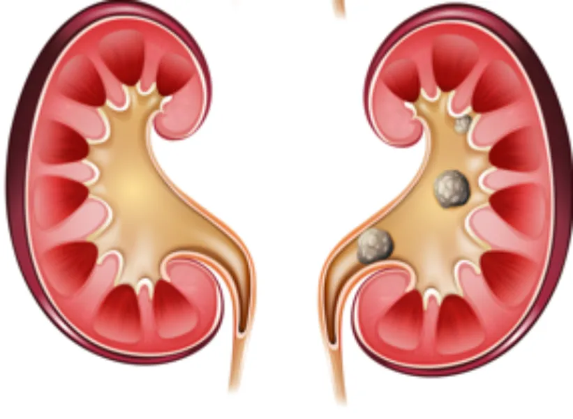 Kidney Stone Removal Treatment in Thane West