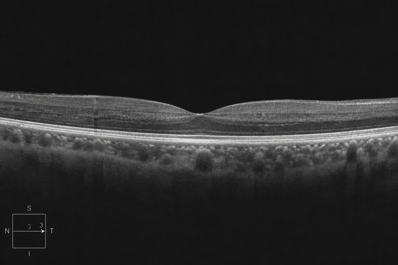 OCT Scan for Retina in Chandigarh