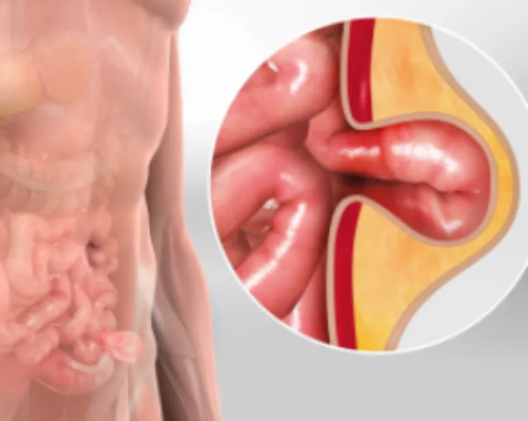 Laparoscopic Hernia Repair Surgery in Thane for Better Daily Comfort