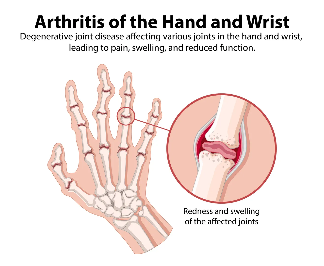Arthritis of the Hand Treatment in Matunga – Managing Stiffness Before It Progresses