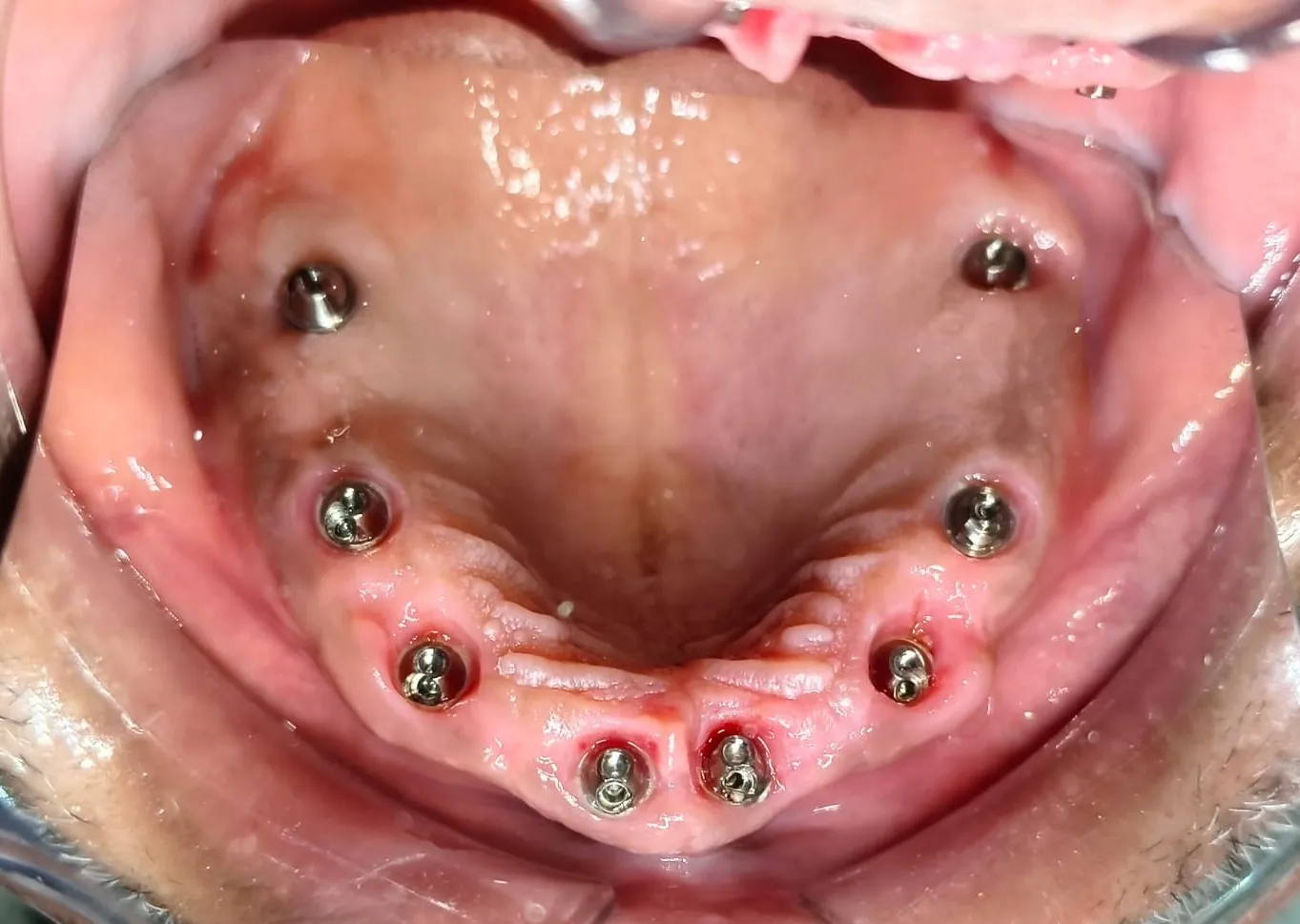 Dental Implants in Mulund West Mumbai: Procedure, Healing & Cost
