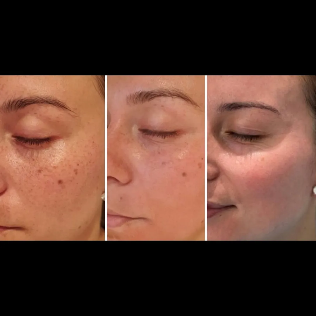 Cosmelan peel Treatment In Vashi