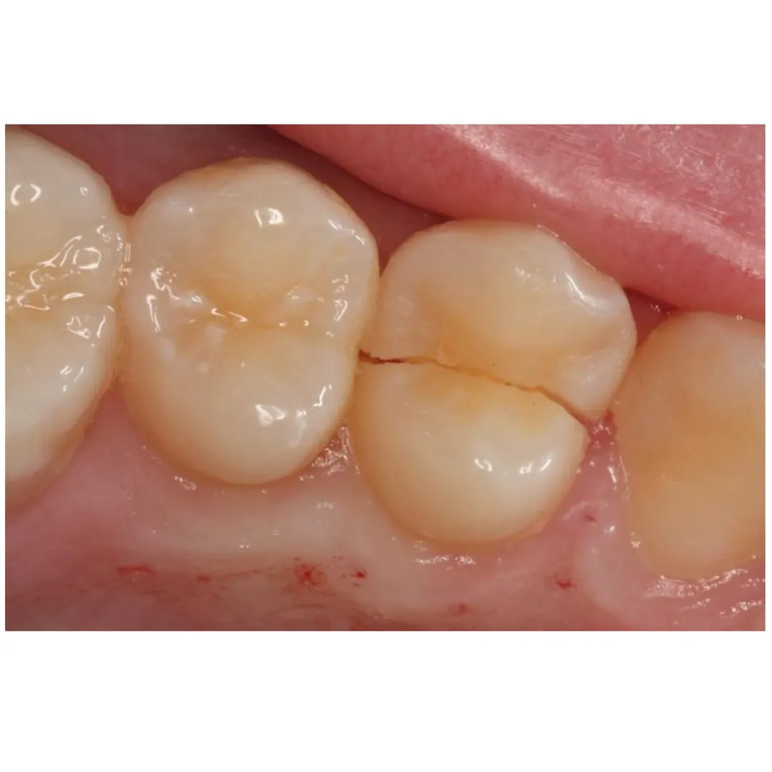 Your Trusted Choice for Cracked Tooth at CGHS Empaneled clinic
