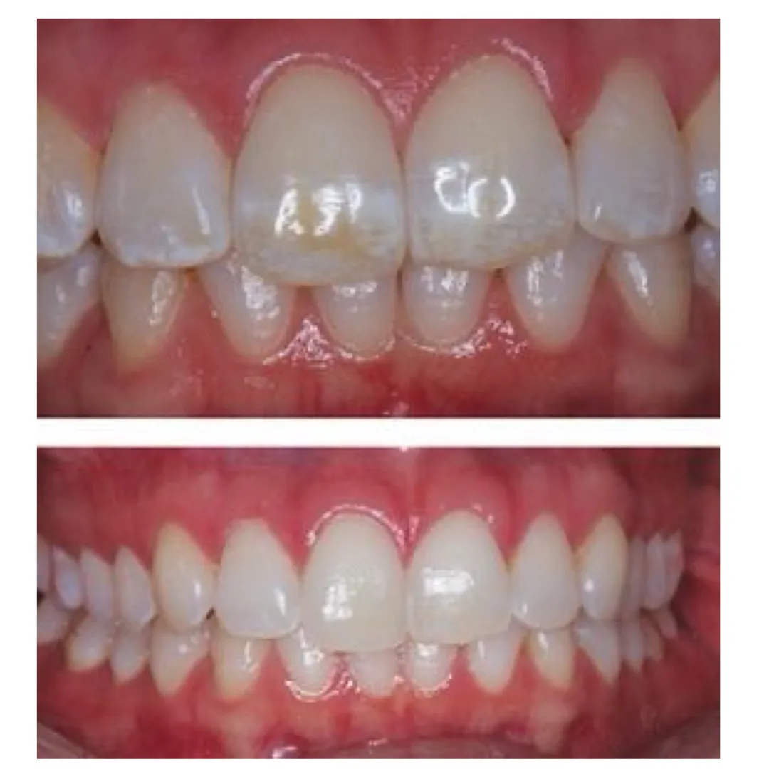 Dental Fluorosis: Causes, Symptoms and Effective Treatment Options for Patients in Lajpat Nagar