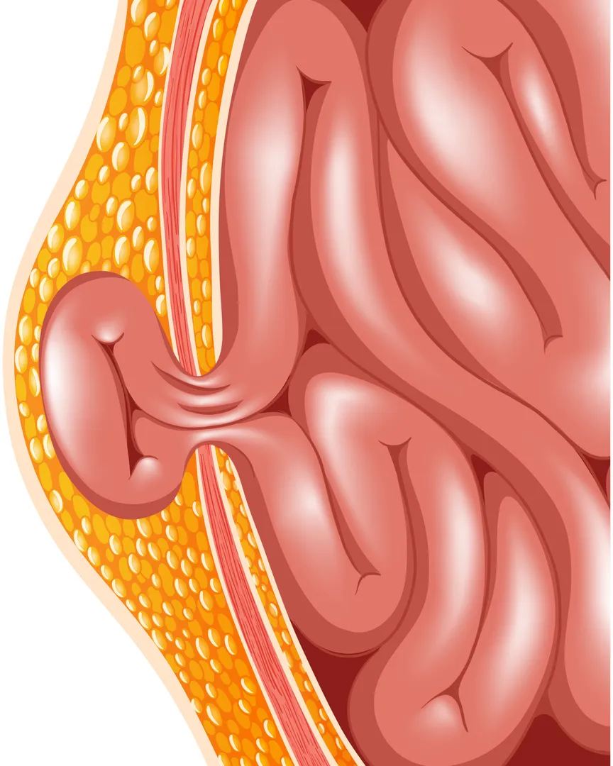 Hernia Treatment Surgeon in Hinjawadi