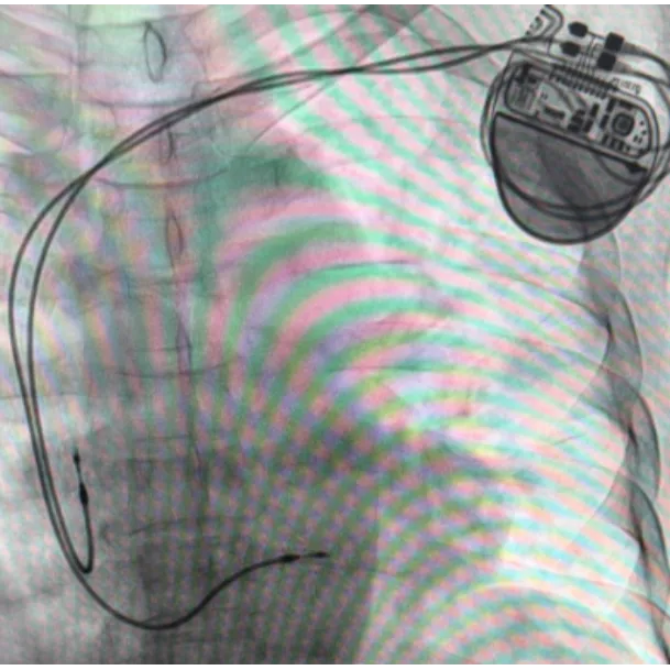 Pacemakers in Pune – Reliable Support for Irregular Heart Rhythms