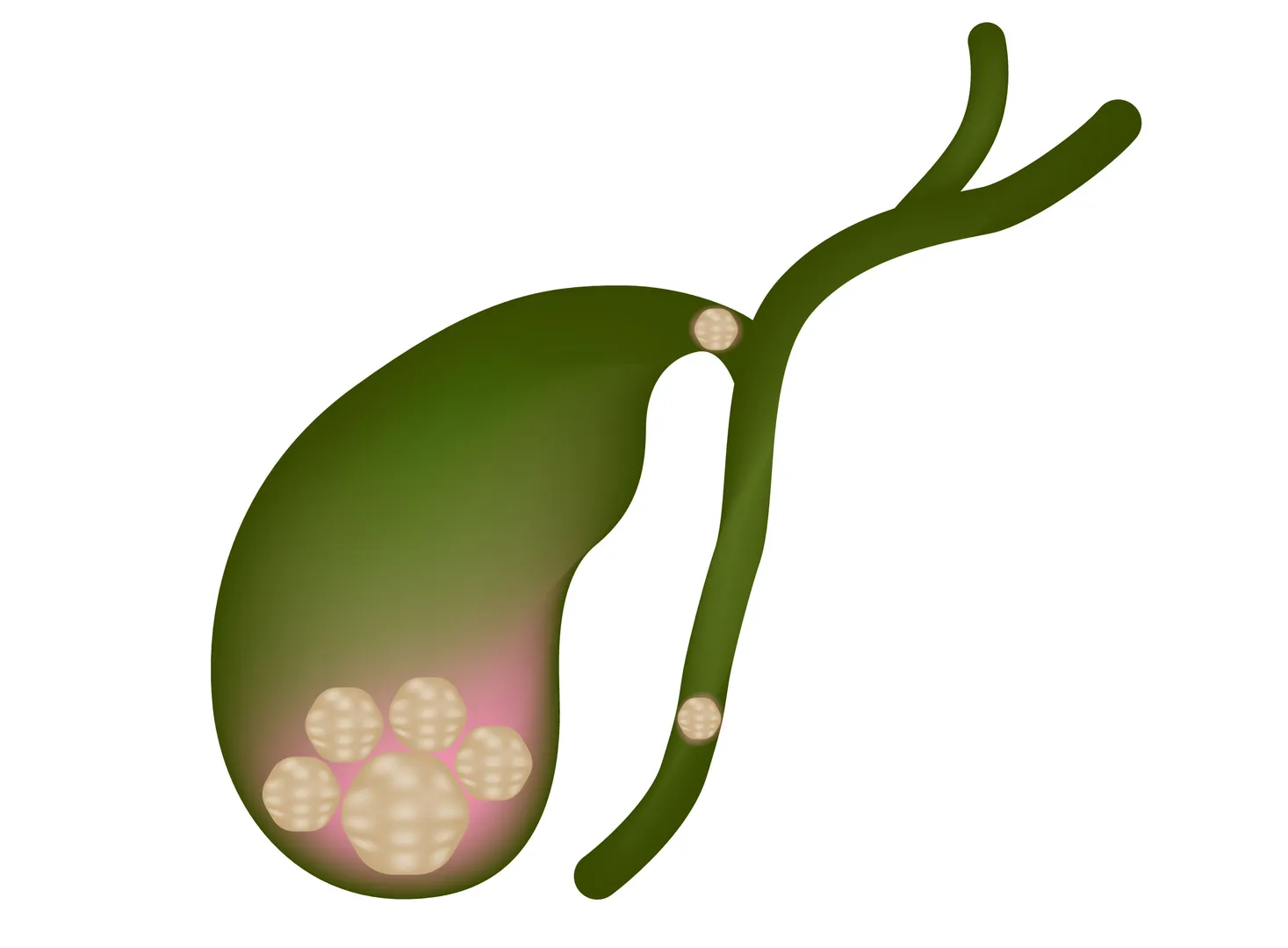 Gallbladder Stone Treatment Specialist in PCMC for Lasting Relief from Recurrent Gallstone Problems