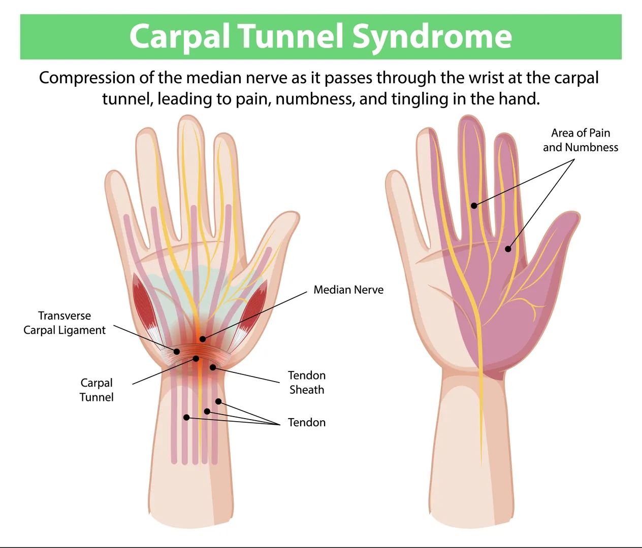 Carpal Tunnel Syndrome Treatment in Sion – Managing Numbness and Hand Weakness Early