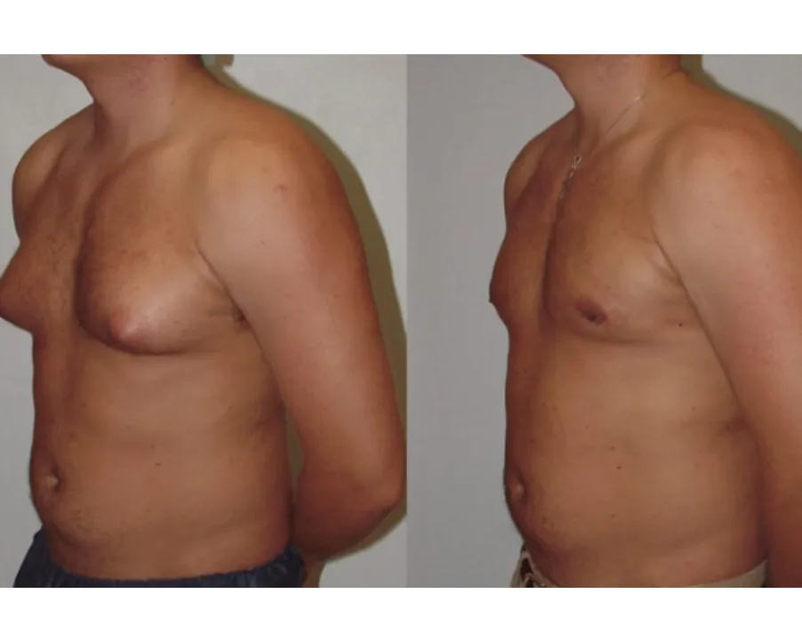 Gynecomastia Surgery in Kolathur for Improved Confidence and Body Comfort