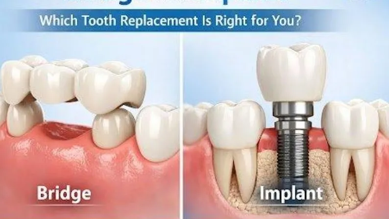 Dental Implant vs Bridge: Which Option Is Better for Missing Teeth in Thane?