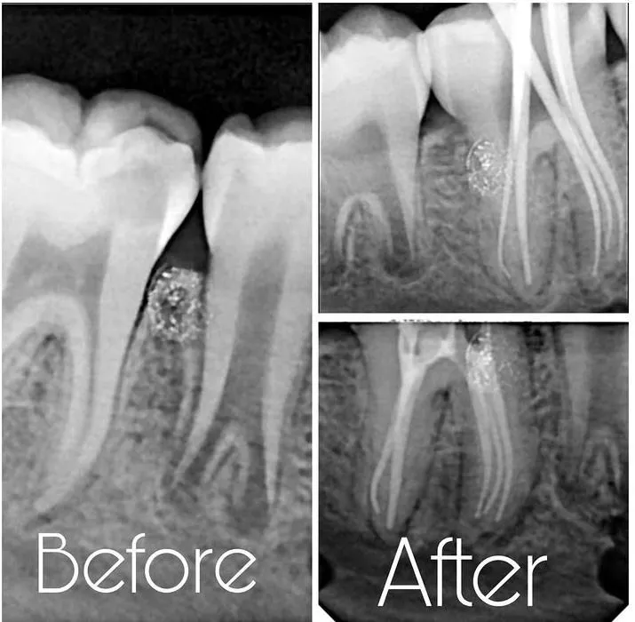 How Long Does Root Canal Treatment Take? Timeline Explained by Dentists in Mulund West Mumbai