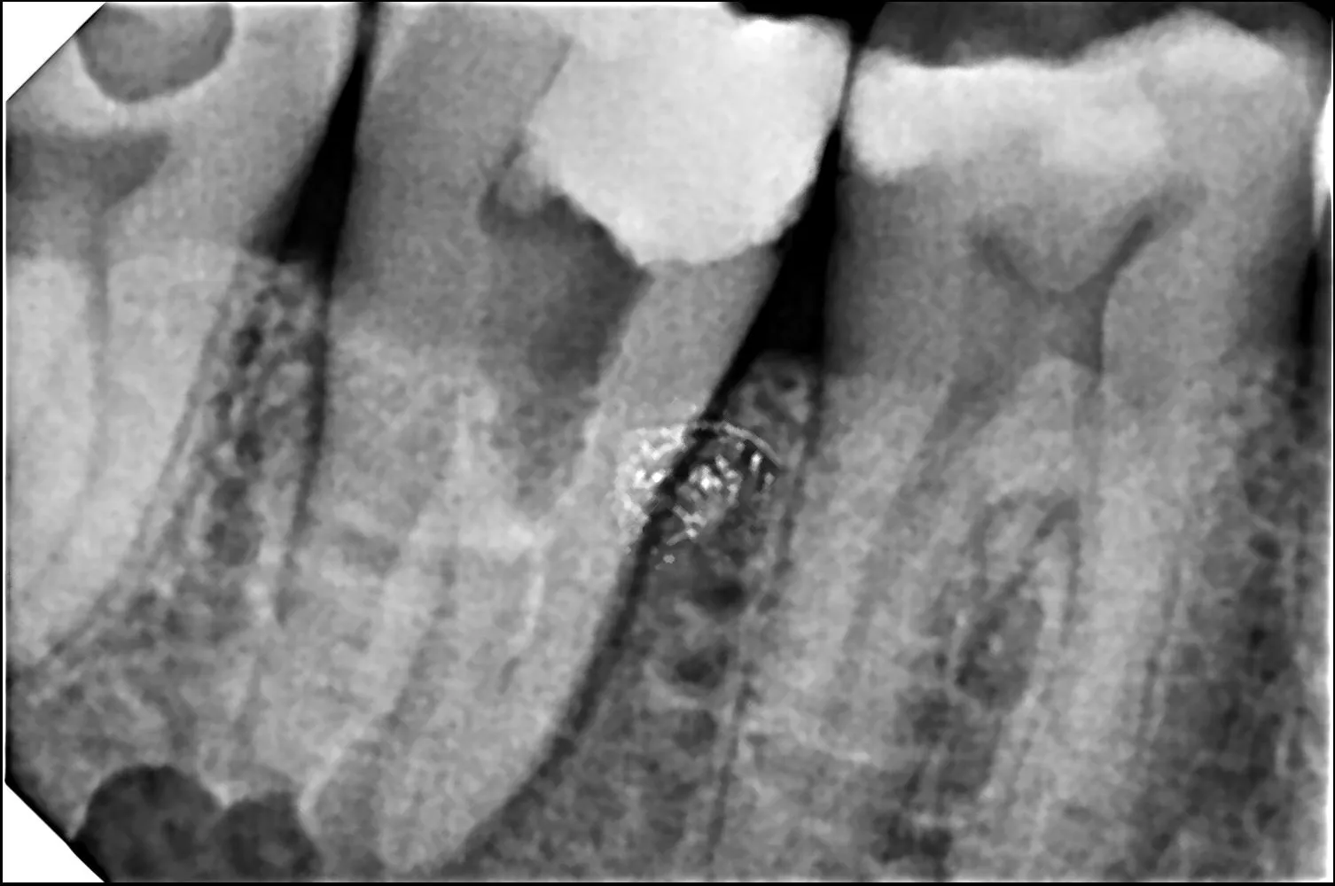 Emergency Dentist in Thane: What to Do During Severe Tooth Pain