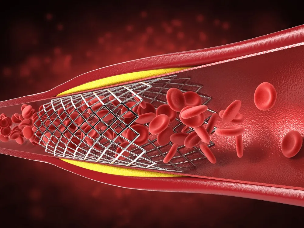 Angioplasty Surgery in Airoli