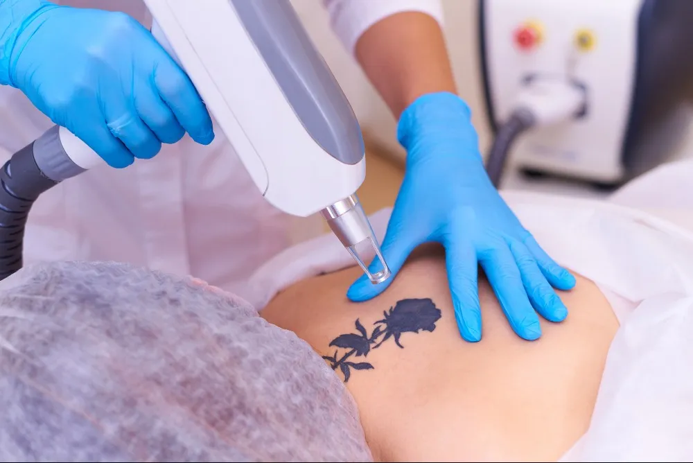Tattoo Removal in Pune for Safe and Effective Ink Reduction