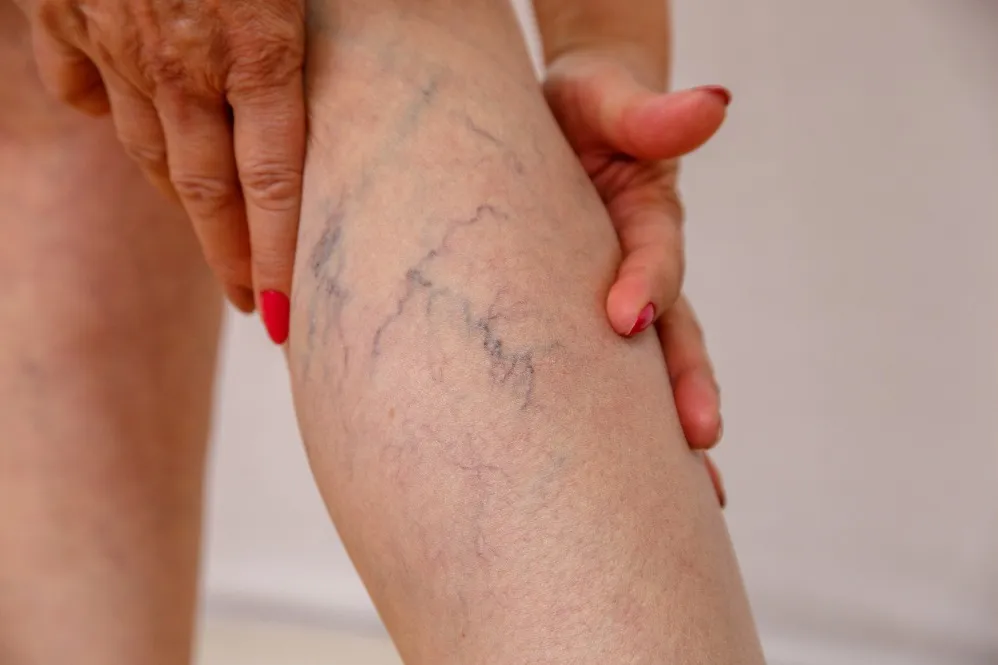 Varicose Vein Treatment in Malad