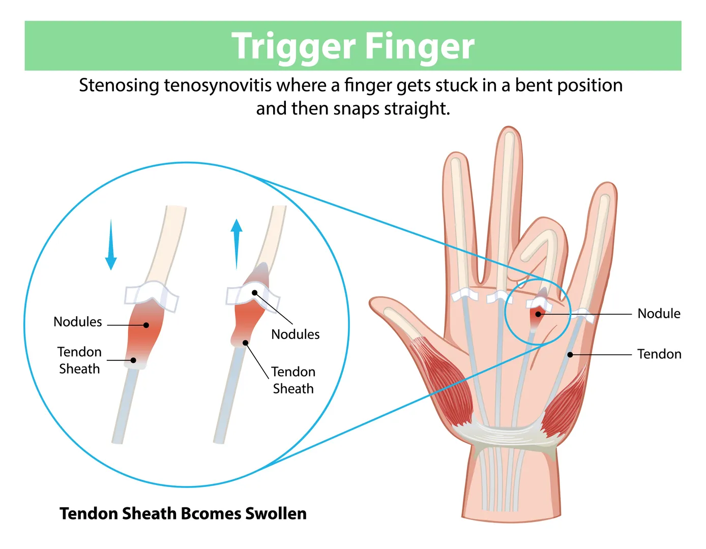Trigger Finger Treatment in Chembur – Restoring Smooth Finger Motion